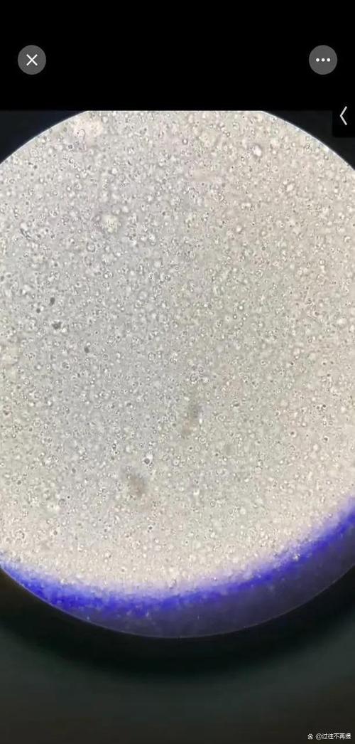 男人无精症有什么症状表现