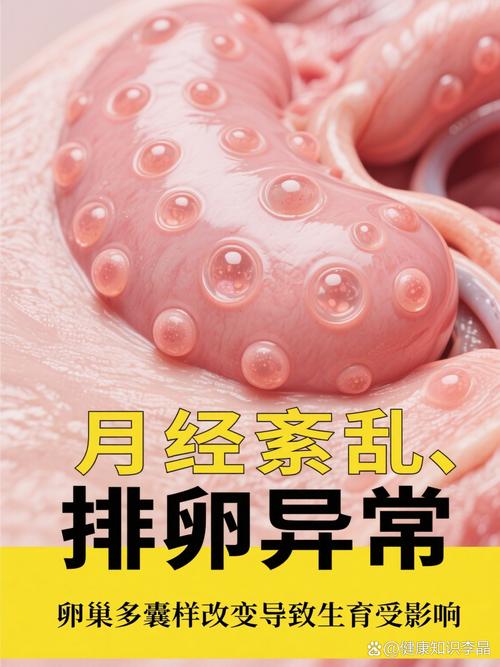 多囊卵巢综合征的治疗和怀孕几率 多囊卵巢综合征的治疗和怀孕几率