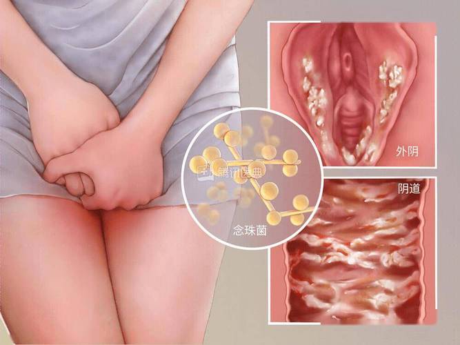 常见的妇科病有哪几种 常见的妇科病有哪几种