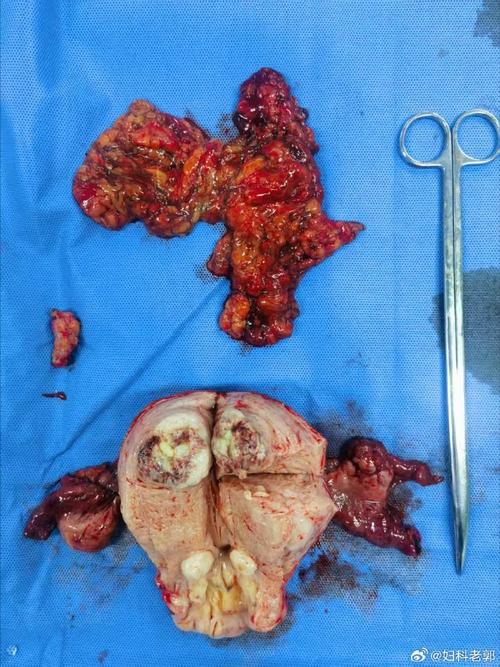 一个被低估了中成药,它是治疗“老烂腿”的“神药”! 一个被低估了中成药,它是治疗“老烂腿”的“神药”!