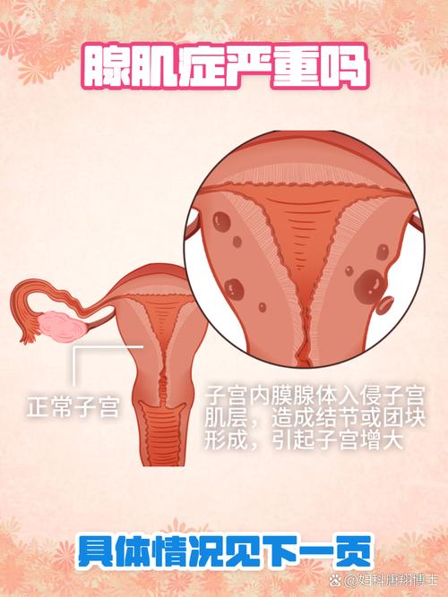 子宫腺肌症的典型症状是什么如何处理 子宫腺肌症的典型症状是什么如何处理